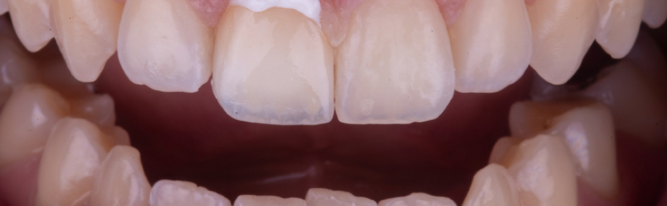 Bezpośrednia licówka kompozytowa w odcinku przednim wykonana z użyciem uniwersalnego kompozytu typu bulk-fill z uproszczonym systemem odcieni – opis przypadku klinicznego