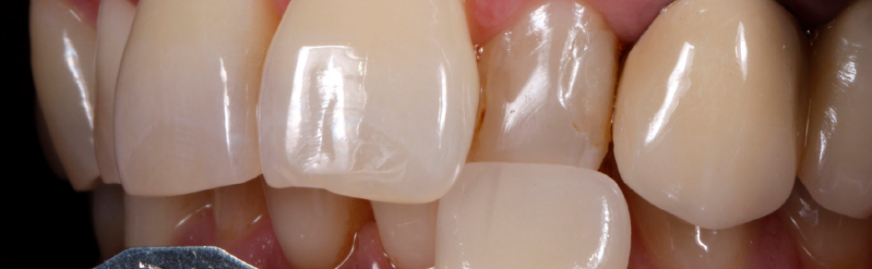 Odbudowa pewności siebie po urazie: podejście biomimetyczne – reportaż kliniczny