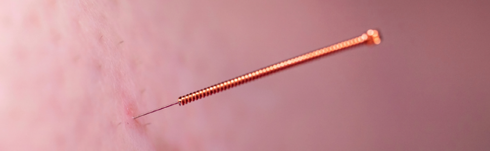 ﻿Suche igłowanie w leczeniu bólu mięśniowo-powięziowego. Mechanizmy działania i efekty terapeutyczne – praca przeglądowa