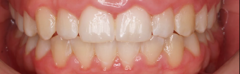 Chirurgiczne wydłużanie koron 