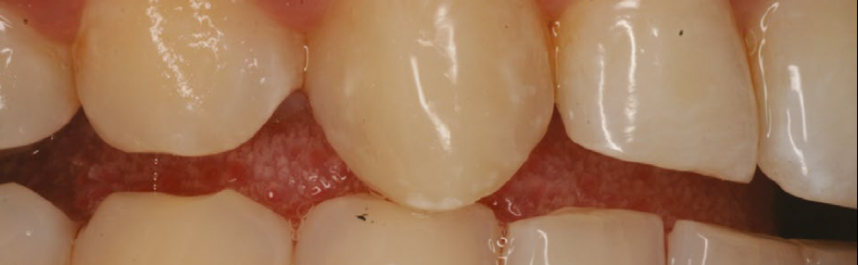 Bezpośrednia odbudowa prowadzenia na kłach