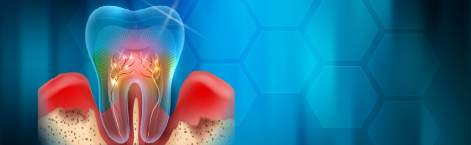 Ryzyko choroby przyzębia u pacjentów z łuszczycą – przegląd piśmiennictwa