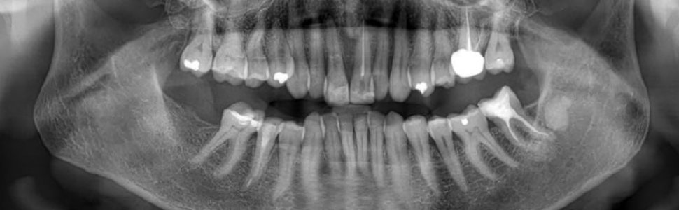 OPIS PRZYPADKU. Koncepcja zachowawczego postępowania w złamaniu koronowo-korzeniowym z użyciem materiału kompozytowego - opis przypadku