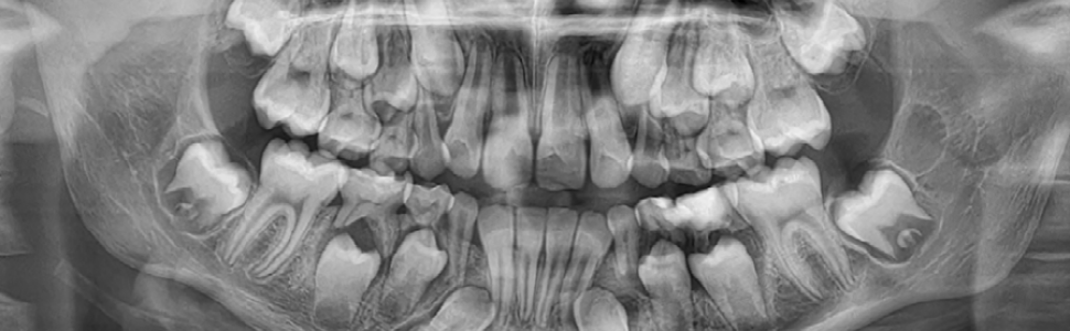 OPIS PRZYPADKU. Złamanie trzonu żuchwy w wieku rozwojowym - opis przypadku