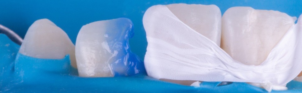 REPORTAŻ KLINICZNY. Przywracanie naturalnego uśmiechu. Technika warstwowej odbudowy kompozytowej - odcienie PREMIUM