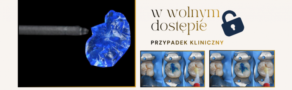 REPORTAŻ KLINICZNY. Flow Injection i technika stempla. Odbudowa zębów w odcinku bocznym