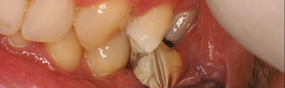 PROCEDURA. Bezpośrednia odbudowa zębów przednich 