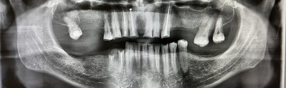 OPIS PRZYPADKU. Dwuetapowa rehabilitacja pacjenta z obniżoną wysokością zwarcia za pomocą pracy kombinowanej – opis przypadku 