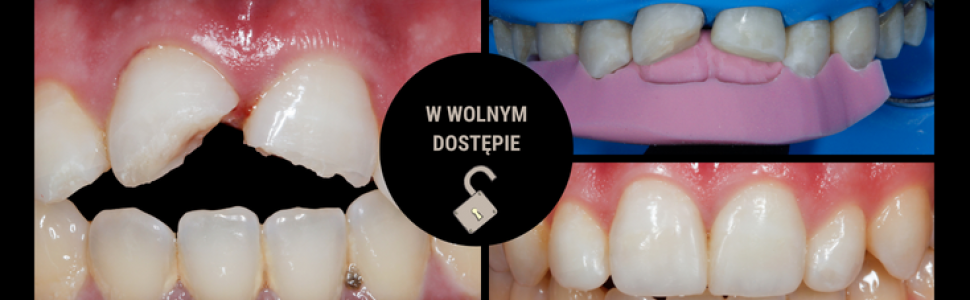 Zastosowanie kompozytów w bezpośredniej odbudowie zębów przednich po urazie