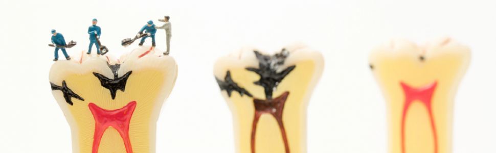 ARTYKUŁ ORYGINALNY. Trudności w diagnozowaniu pionowych złamań korzeni zębów leczonych endodontycznie 