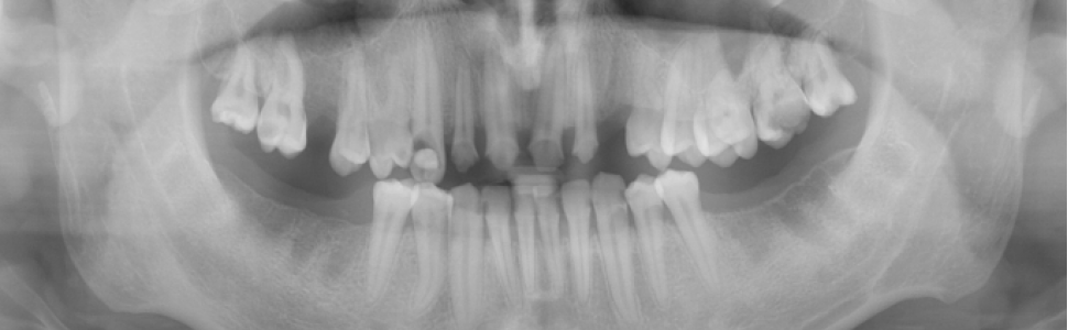OPIS PRZYPADKU. Martwicze zapalenie przyzębia z wydzieleniem martwiaka kostnego - opis przypadku