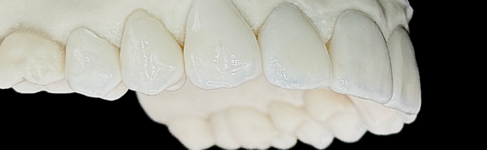 Zastosowanie pośrednich licówek kompozytowych Grandio Disc w technologi CAD/CAM w leczeniu odtwórczym no-prep u pacjentów po leczeniu ortodontycznym – opis przypadku