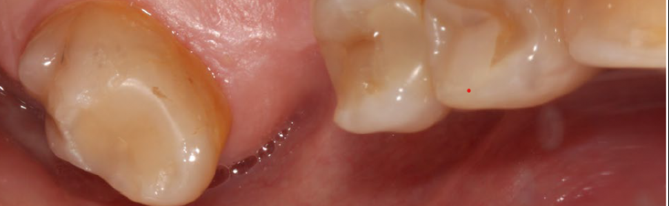 OPIS PRZYPADKU. Cyfrowy protokół implantacji w odcinku tylnym przy użyciu szablonu chirurgicznego – opis przypadku leczonego pacjenta