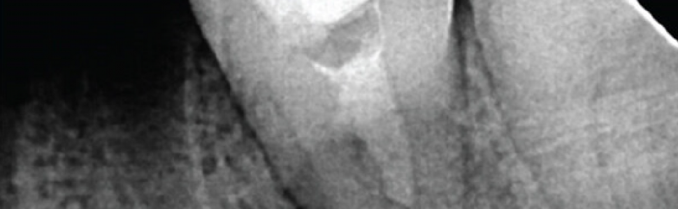 EDUKACJA. A Rare Case of Orthograde Retrieval of Extruded Instrument following Periapical Tissue Healing – Case Report – Ahmed Elhakim, Tarek Mohamed Abd El-Wahan