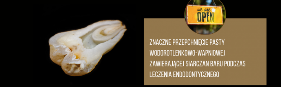 Powikłania po leczeniu endodontycznym. Dostęp otwarty!