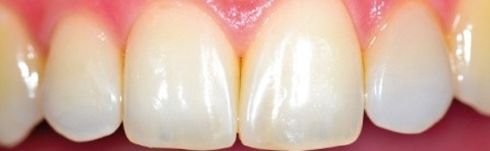 Minimalnie inwazyjna poprawa estetyki zębów siecznych szczęki za pomocą materiału złożonego