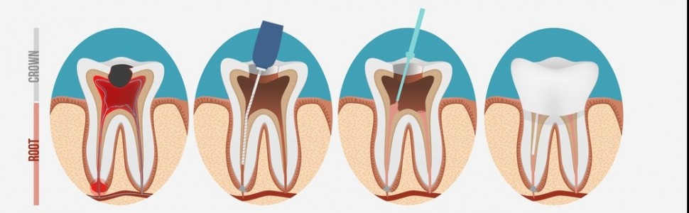 Mapa endodontyczna zębów trzonowych