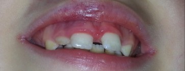 SPECJALISTA RADZI: Zapalenie kątów ust – czy to jedynie lokalny problem?