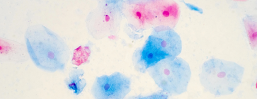 SPECJALISTA RADZI. Zakażenie HPV w jamie ustnej 