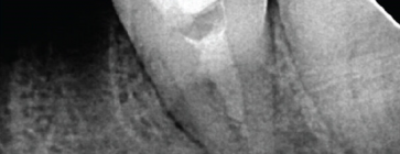 EDUKACJA. A Rare Case of Orthograde Retrieval of Extruded Instrument&hellip;