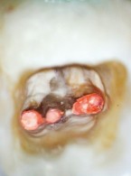 Powtórne leczenie endodontyczne pierwszego zęba trzonowego żuchwy z pięcioma kanałami