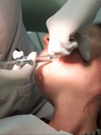 Przepchnięcie podchlorynu sodu – doświadczenia lekarzy dentystów posiadających Certyfikat Amerykańskiej Rady Endodoncji 