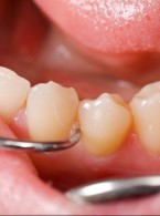 Sposób postępowania z głęboko zatrzymanym  zębem trzonowym trzecim żuchwy i rozległą torbielą zębopochodną,  mający na celu uniknięcie urazu nerwu zębodołowego oraz  poprawienie gojenia się tkanek przyzębia – opis przypadku