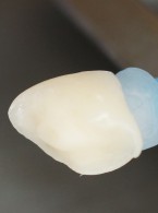 Rekonstrukcja korony leczonego endodontycznie zęba złamanego 