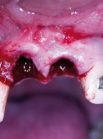 Metody zapobiegania zanikowi wyrostka zębodołowego po ekstrakcji zębów