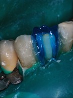 Odbudowy kompozytowe jako alternatywa leczenia ortodontycznego – fotoreportaż kliniczny