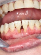 Patologiczna migracja zębów w przebiegu chorób przyzębia