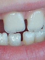 Adhezyjna technika odbudowy złamanego zęba z wykorzystaniem fragmentu własnej korony