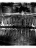 Trudne sytuacje w endodoncji
