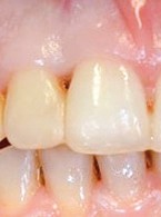 Wykorzystanie kwasu hialuronowego w periodontologii 
