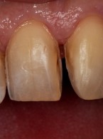 Rekonstrukcja tkanek zębów przednich po urazie z wykorzystaniem licówek ceramicznych 