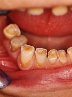 Planowanie leczenia i leczenie przedprotetyczne pacjenta z patologicznym starciem zębów