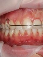 Pacjentka z zatrzymanym atypowym zębem 21