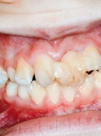 Postępowanie u pacjentów z urazowymi złamaniami korzeni zębów stałych