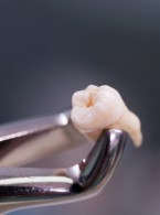 Jatrogenne złamanie żuchwy spowodowane usunięciem trzeciego zęba trzonowego. Czy można mu zapobiec?