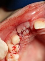 Przygotowanie pacjentki z zatrzymanym zębem 12 do leczenia implantologicznego 