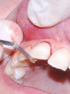 Pourazowa odbudowa zęba siecznego przyśrodkowego szczęki z wykorzystaniem odłamanego zrębu