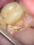Rozwiązanie problemu złamania poddziąsłowego korony zęba przedtrzonowego – opis dwóch przypadków
