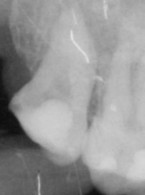 Leczenie endodontyczne zębów trzonowych trzecich
