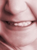 Zamierzona replantacja całkowicie zwichniętego niedojrzałego zęba siecznego stałego. Opis przypadku