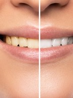 Wybielanie przebarwionego zęba z usunięciem resztek po skutecznej endodoncji regeneracyjnej
