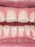 Długotrwałe utrzymanie całkowicie zwichniętych stałych zębów siecznych szczęki po opóźnionej replantacji i nieprawidłowym przechowywaniu
