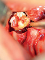 Zatrzymany ząb mądrości w atroficznej żuchwie przyczyną ropnia przestrzeni przygardłowej u pacjenta geriatrycznego. Opis przypadku