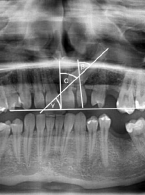 Resorpcja korzeni zębów sąsiadujących z zatrzymanym kłem – przegląd piśmiennictwa. Część I
