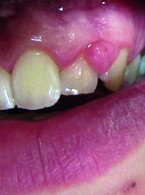 Najczęściej występujące zmiany w jamie ustnej u kobiet w ciąży. Zalecenia higieniczno‑dietetyczne − przegląd piśmiennictwa