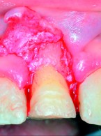 Wielospecjalistyczne leczenie estetyczne skośnego koronowo‑korzeniowego złamania zęba siecznego przyśrodkowego. Opis przypadku
